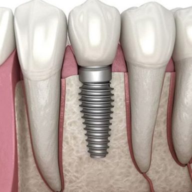 Trồng Răng Implant Dùng Được Bao Lâu? Các Yếu Tố Ảnh Hưởng