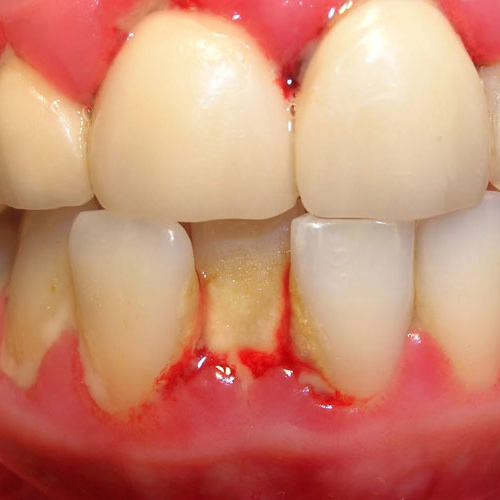 Viêm nha chu vẫn có thể trồng răng Implant như bình thường