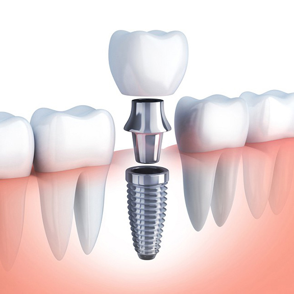 Kỹ thuật cấy ghép Implant giúp phục hồi răng bị mất