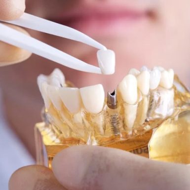 Khám Phá Kỹ Thuật Cấy Ghép Implant: Quy Trình Và Ưu Điểm