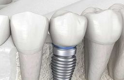 Trụ Implant Anthogyr: Cấu Tạo, Quy Trình, Thời Gian Và Chi Phí