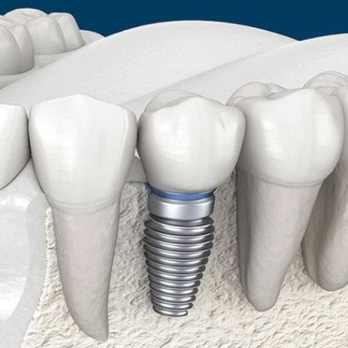 Trụ Implant Anthogyr: Cấu Tạo, Quy Trình, Thời Gian Và Chi Phí