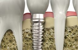 Tổng Quan Trụ Implant Dentium Superline Và Lưu Ý Quan Trọng