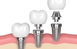 Trụ Implant Mỹ Paltop: Xuất Xứ, Ưu Nhược Điểm Và Chi Phí