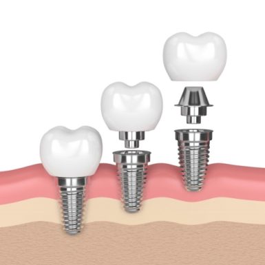 Trụ Implant Mỹ Paltop: Xuất Xứ, Ưu Nhược Điểm Và Chi Phí