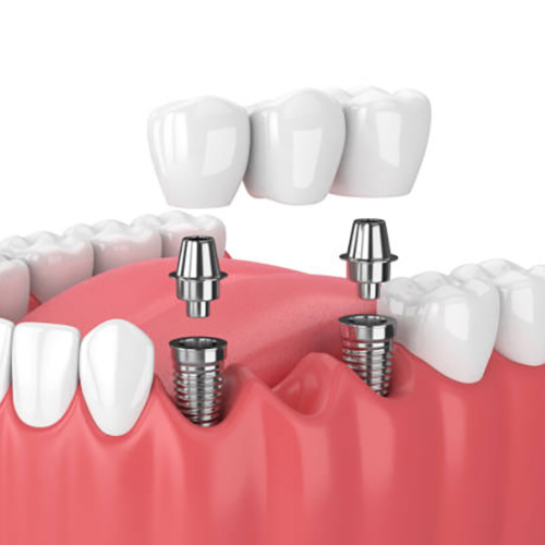 Trụ Implant Paltop chưa phổ biến tại Việt Nam